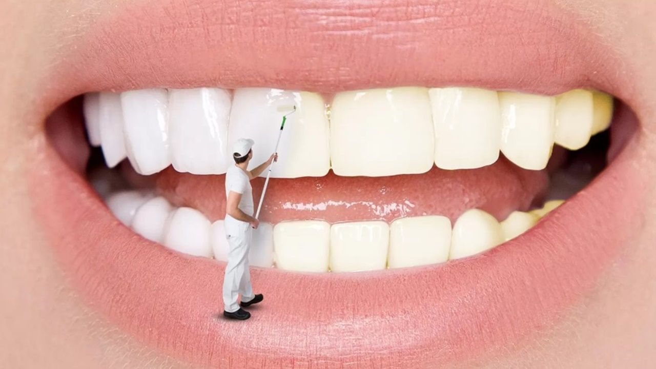 Evde diş beyazlatma için doğal yöntem: Hidrojen peroksit